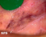 lichen planus of the mucosa