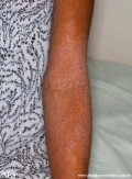 atopic dermatitis