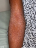 atopic dermatitis