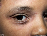 atopic dermatitis