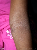 atopic dermatitis