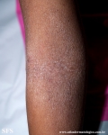 atopic dermatitis