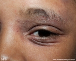 atopic dermatitis