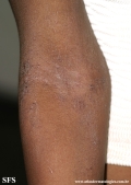 atopic dermatitis