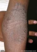 atopic dermatitis