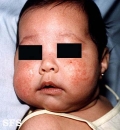 atopic dermatitis