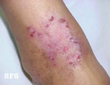 atopic dermatitis