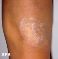 atopic dermatitis