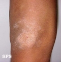 atopic dermatitis