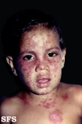 atopic dermatitis