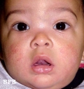 atopic dermatitis