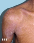 atopic dermatitis