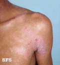 atopic dermatitis