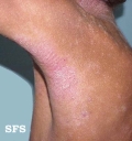atopic dermatitis