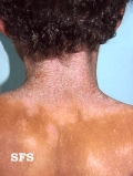 atopic dermatitis