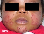 atopic dermatitis