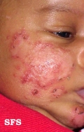 atopic dermatitis