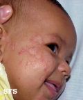 atopic dermatitis
