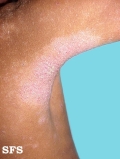 atopic dermatitis