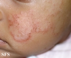 atopic dermatitis
