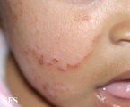 atopic dermatitis