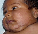 atopic dermatitis