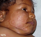 atopic dermatitis