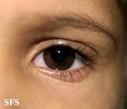 atopic dermatitis