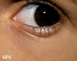 atopic dermatitis
