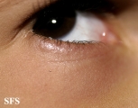 atopic dermatitis