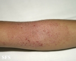 atopic dermatitis