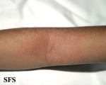 atopic dermatitis