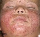 atopic dermatitis