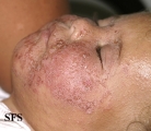 atopic dermatitis