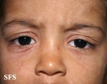 atopic dermatitis