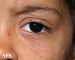 atopic dermatitis