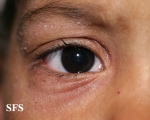 atopic dermatitis