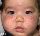 atopic dermatitis