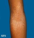atopic dermatitis