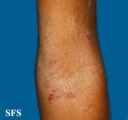atopic dermatitis