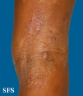 atopic dermatitis