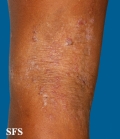atopic dermatitis