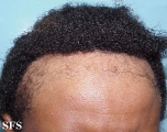 traction-traumatic alopecia