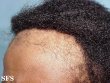 traction-traumatic alopecia