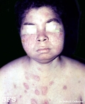 pemphigus foliaceus-localized form
