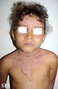pemphigus foliaceus-localized form
