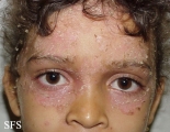 pemphigus foliaceus-localized form