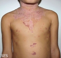 pemphigus foliaceus-localized form
