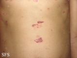 pemphigus foliaceus-localized form