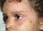 pemphigus foliaceus-localized form